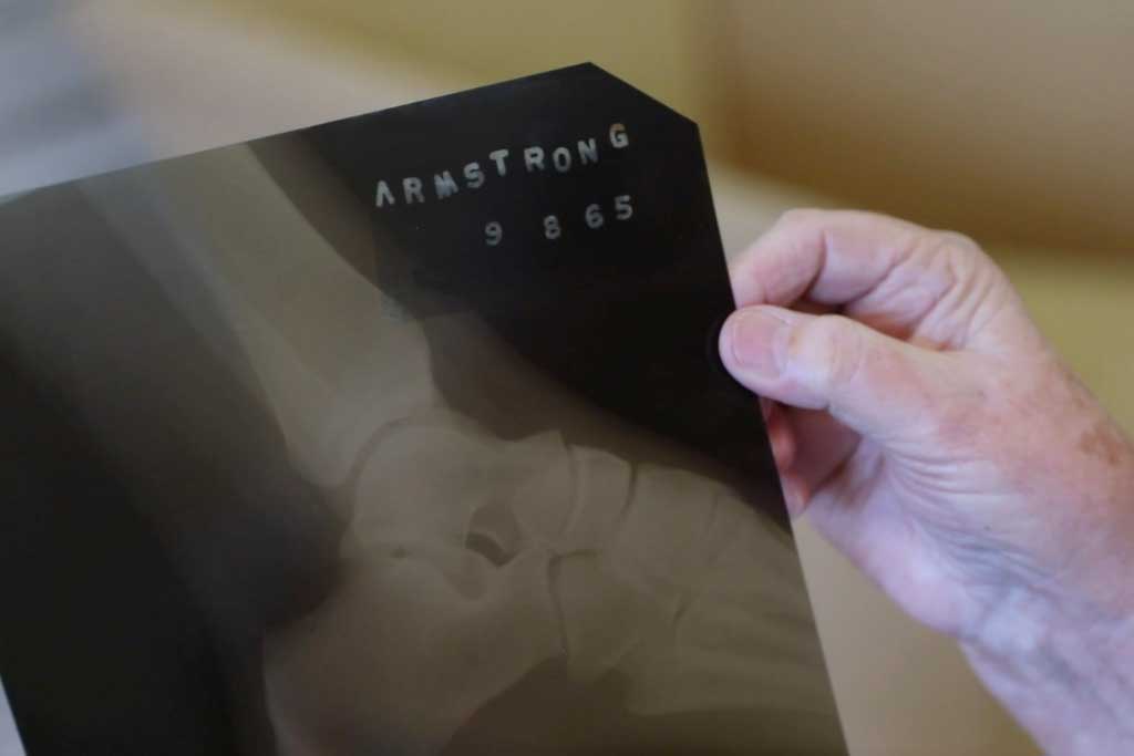 An X-Ray taken by Dr. Mack of Armstrong's ankle.